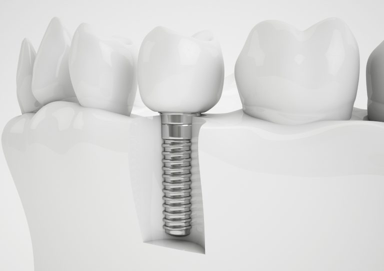 implantat - Stomatoloska ordinacija DENT IN PLUS Kraljevo