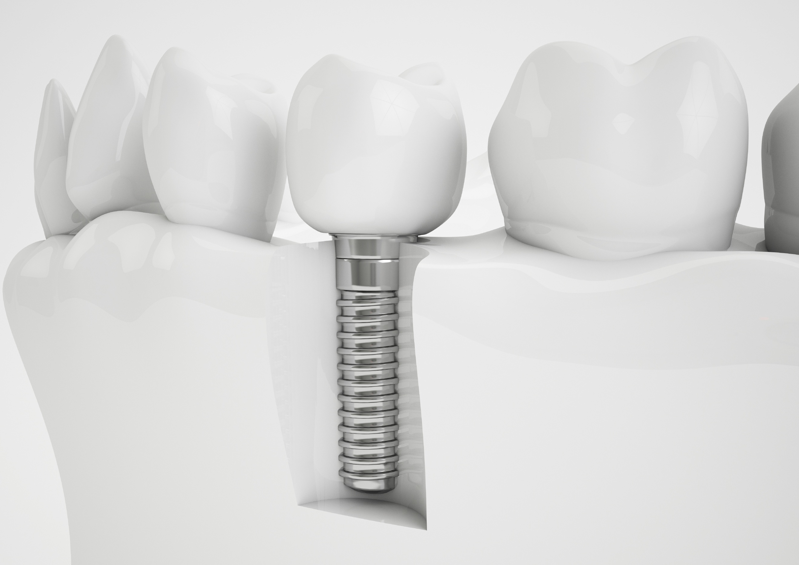 Zubni Implantat