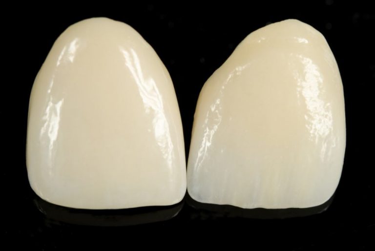 Dentalne fasete-viniri